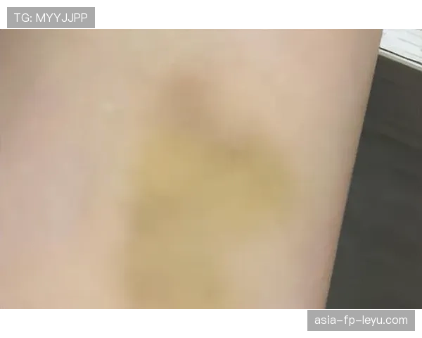 身体碰撞的闷响像骨头断掉，身体碰撞会出现淤青什么原因